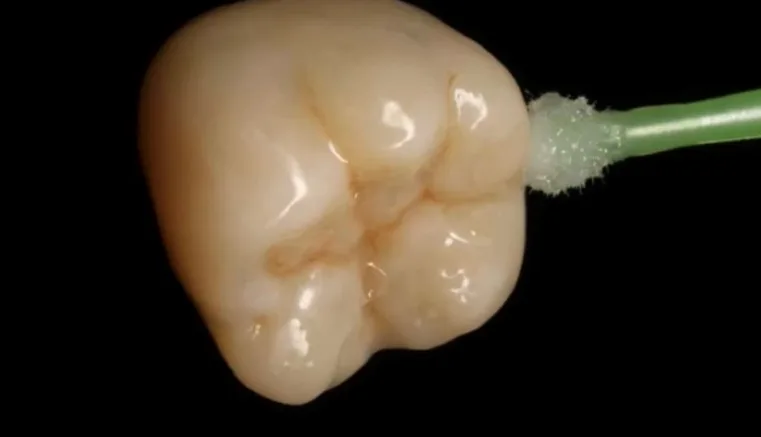 Print-Crowntec ile üretilmiş dental restorasyon